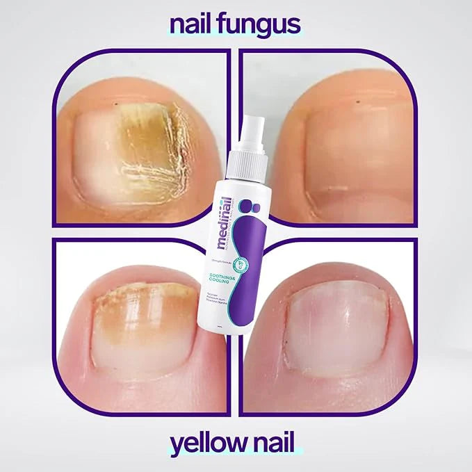 Nail Fungus Treatment Spray – Fast-Acting Formula for Healthy, Clear Nails